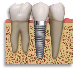 single implant