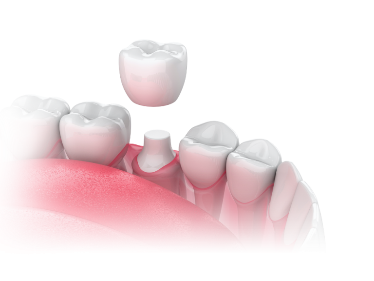 Porcelain Dental Crowns Hillsborough New Jersey NJ