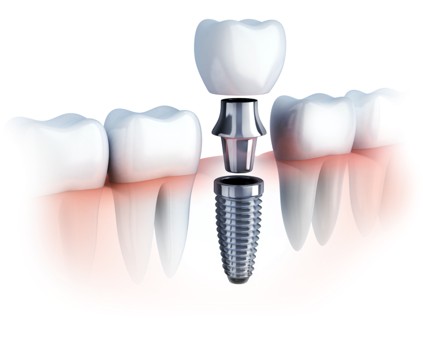 Teeth Implants Albany Ny