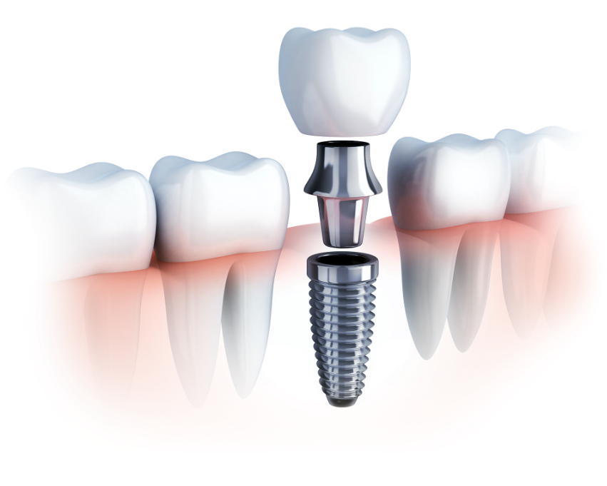 All On 4 Dental Implants Albany Ny