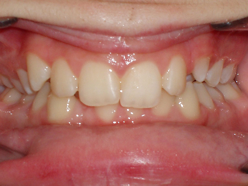 Teeth whitening nj cost